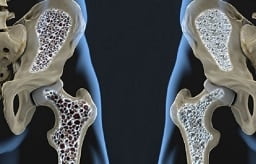 imagem 3D mostrando osteoporose nos ossos do quadril