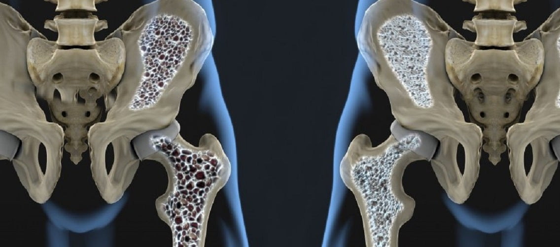 imagem 3D mostrando osteoporose nos ossos do quadril