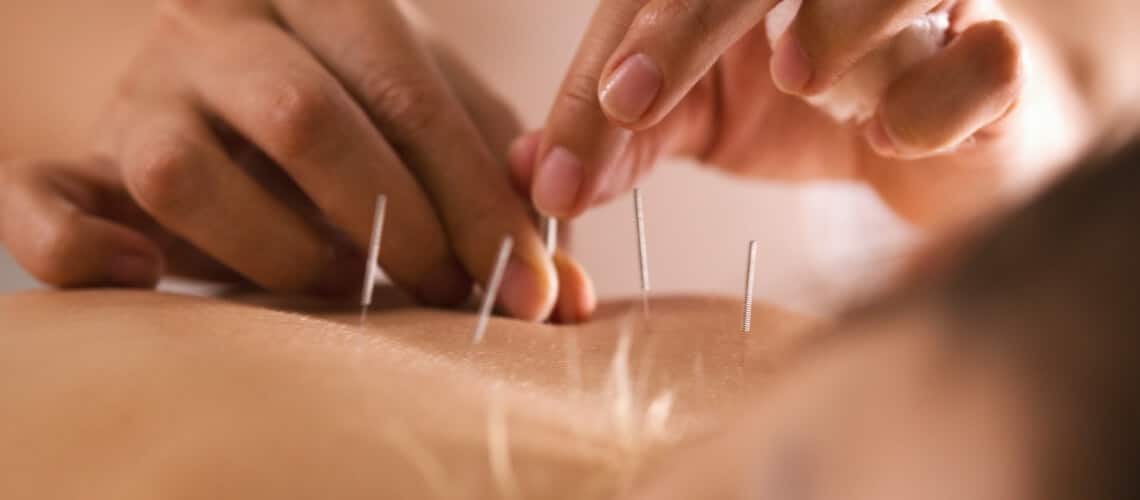 mãos manuseando agulhas de acupuntura sobre a pele