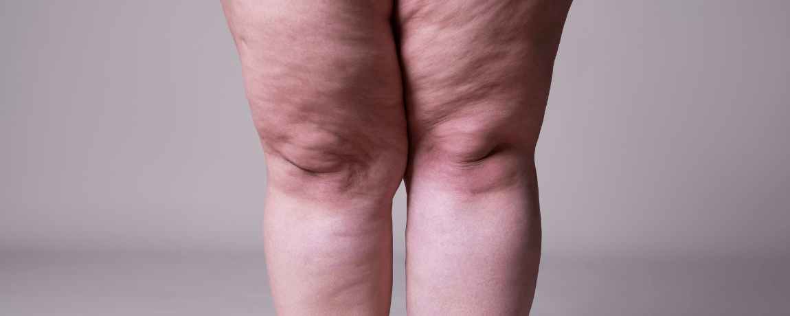 lipedema