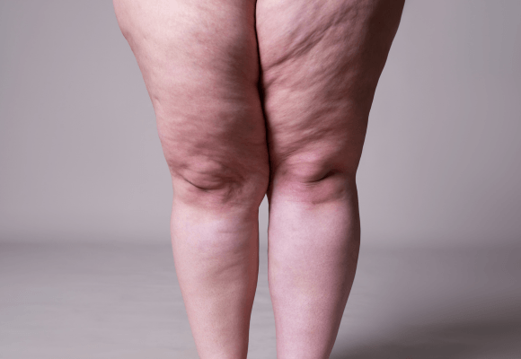 lipedema
