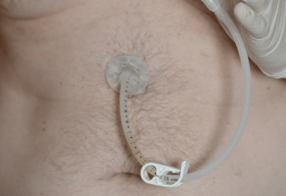 O Que é Gastrostomia Endoscópica Percutânea Nutritotal Pro 2905