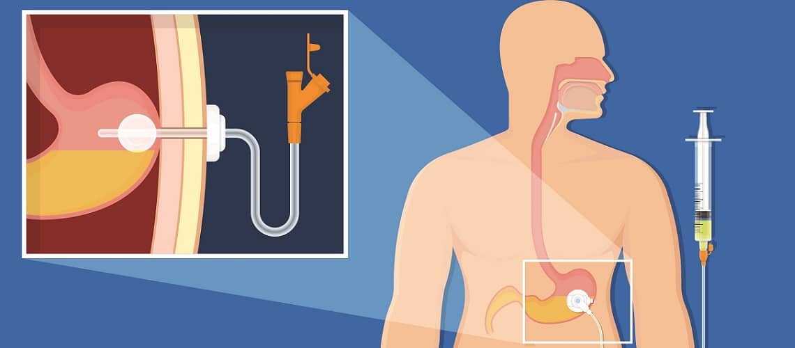 Quando Indicar Terapia Nutricional Enteral Por Ostomias Em Adultos Nutritotal Pro