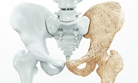 Esqueleto, um lado branco e outro amarelado, demonstrando desgaste pela osteoporose