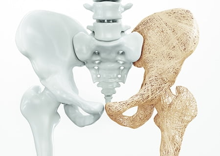 Esqueleto, um lado branco e outro amarelado, demonstrando desgaste pela osteoporose